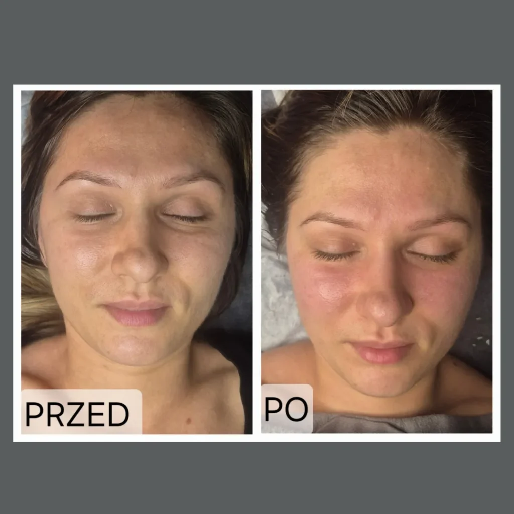 Kobido Białystok – efekt przed i po masażu liftingującym twarzy